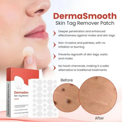 DermaSmooth Skin Tag Remover Patch – Fast, Safe &amp; Painless Skin Tag &amp; Mole Removal | Nano-Microneedle Technology | 72 Patches