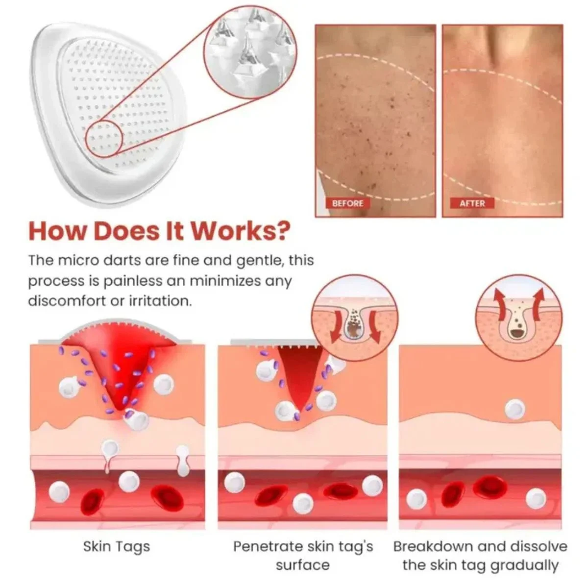 DermaSmooth Skin Tag Remover Patch – Fast, Safe &amp; Painless Skin Tag &amp; Mole Removal | Nano-Microneedle Technology | 72 Patches